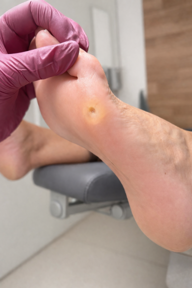 Hühneraugenentfernung