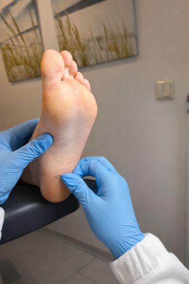 Abtragung von Hornhaut